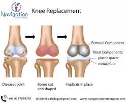 Navigation Joint Surgeon Uses Special Instruments Which Are Attached To The Patients Using Th Total Knee Replacement Knee Replacement Knee Replacement Surgery