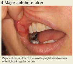 Image result for Labial mucosa