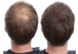 9 Hair Fiber Ideen Volleres Haar Geheimratsecken Haare