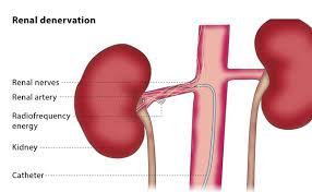 Evaluation of acute renal colic: Renal Denervation Cirse