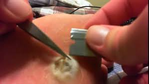When my son was 8 years old i noticed that he had a few warts on his fingers. Plantars Wart Removal Video Dailymotion