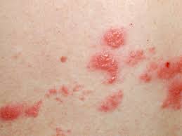 Gambar dekoratif merupakan gambar dengan corak dekor atau hias. Benarkah Penyakit Cacar Ular Bisa Menyebabkan Kematian