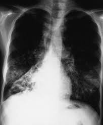 Learn about its symptoms, causes, diagnosis, and treatment. Zystische Fibrose Padiatrie Msd Manual Profi Ausgabe