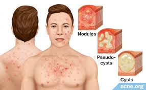 Image result for acne