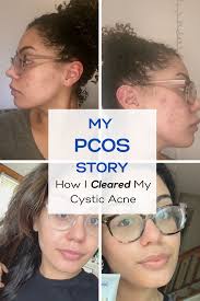 Zwar geht auch rosazea mit einer erhöhten talgproduktion einher, diese führt jedoch nicht zur entstehung von mitessern. My Pcos Story In 2021 Cystic Acne Cystic Acne Treatment Chin Acne Treatment