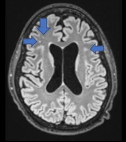 Brain Dead or Alive: A Case Report of Inaccurate Neurological  Prognostication | Cureus
