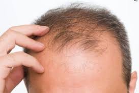 علاج علاج نباتي Stop Hair Loss Hair Loss Diffuse Hair Loss