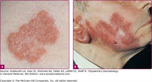 The tuberculosis cutis luposa had been misdiagnosed as cutaneous leishmaniasis and surgically treated. Tuberculosis And Infections With Atypical Mycobacteria Plastic Surgery Key