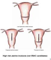 How Long Is C Section Recovery Time History Treatment Complications Types