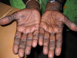 Lichen simplex chronicus (lsc) (also known as neurodermatitis1) is a skin disorder characterized by chronic itching and scratching.2 the constant scratching causes thick, leathery, darkened. Lichen Simplex Chronicus Dr Guru S Blog