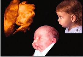 Le syndrome de Pierre Robin