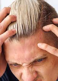 How is itchy scalp and hair loss related? Advice On How To Deal With An Itchy Thinning Crown
