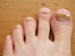 Toenail fungus, also known as onychomycosis is the most commonly caused infection. Toenail Fungus Cure Pictures Home Remedies