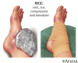 Sprained ankles are the most frequent type of. Sprains Information Mount Sinai New York