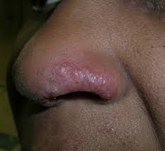 We did not find results for: Red And Swollen Area On Nose Mdedge Family Medicine