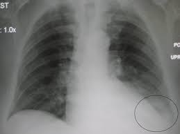 In our study loculated pleural effusion were seen in 8 patients, among which 6 cases were loculated tubercular effusion which were treated with steroids and 2 cases were loculated empyema of which. Parapneumonic Effusion Wikipedia