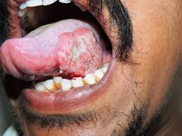 Image result for cancer of tongue