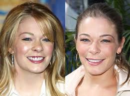 Celebrity Teeth Before And After Celebrity Teeth Celebrity Smiles Skin Bleaching