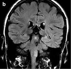 Clippers syndrome with supratentorial and spinal cord involvement and histological anomalies. Https Www 2013 Roentgenkongress De Media Document 3173 Rk Sp 102 1 Forsting Pdf