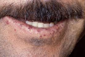 Hereditary Hemorrhagic Telangiectasia Symptoms And Diagnosis