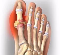 Podagra Priznaki Simptomy I Lechenie U Muzhchin I Zhenshin