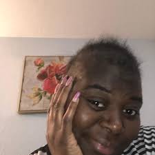 In honor of Alopecia Awareness month I'm sharing my “bald pictures” when I  lost all my hair due to chemotherapy #swipe to see my hair loss process