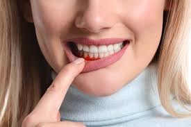 Periodontitis is a gum infection that damages the soft tissue and bone that supports the tooth. The Causes And Symptoms Of Periodontitis