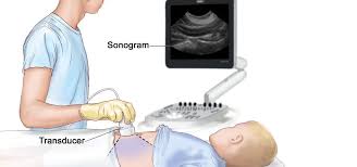 Jul 02, 2021 · transvaginal ultrasound is a test used to look at a woman's uterus, ovaries, tubes, cervix and pelvic area. Abdominal Pelvic Scan Abdominal Pelvic Ultrasound Sifsof