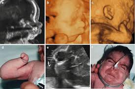 2d 3d 4d Ultrasound Of The Fetal Face In Genetic Syndromes Radiology Key