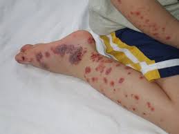 Lascia la tua opinione su piastrinopenia sintomie scopri opinioni su temi relazionati comepiastrinopenia e sintomi. Porpora Trombocitopenica Immune Ospedale Pediatrico Bambino Gesu