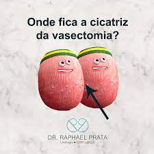 Es un método de control natal o anticonceptivo que puede revertirse, con tasas muy altas de seguridad y efectividad. Dr Raphael Prata Beitrage Facebook