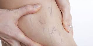 9 من أهم أعراض دوالي الساقين