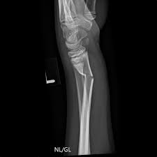 Maybe you would like to learn more about one of these? Wrist Torus And Greenstick Fractures
