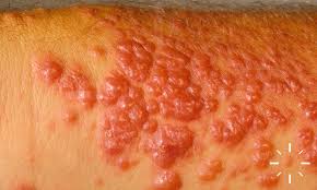 Image result for Erythema Multiforme Major