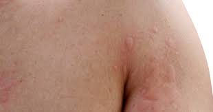 Although they can be incredibly annoying, red, itchy, bumpy rashes are very common. Three Reasons You Might Be Breaking Out In Hives This Summer Starts At 60