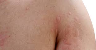 Although they can be incredibly annoying, red, itchy, bumpy rashes are very common. Three Reasons You Might Be Breaking Out In Hives This Summer Starts At 60