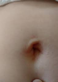 Das ist ein nabelbruch (nabelhernie). Wer Von Euch Erkennt Einen Nabelbruch Gesundheit Und Medizin Medizin Bauch