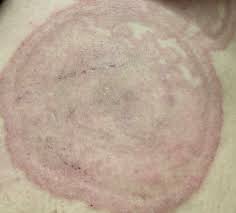 It is a medically proven fact that yeasts start building biofilms over the top of after removing the biofilm we know that medications and herbs effects against yeasts are greatly improved. Steroid Creams Can Make Ringworm Worse Fungal Diseases Cdc