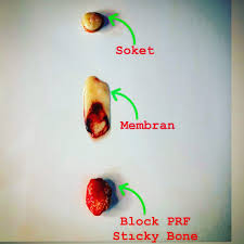 Radar systems radiate each pulse at the carrier frequency during transmit time (or pulse. L Prf Platelet Rich Fibrin Photos Facebook