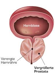 Prostatavergrosserung Ursache Therapie Apogepha