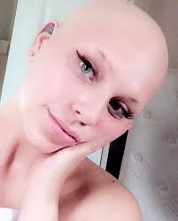 Saçkıran hastası olan Hannah Hosking peruk istiyordu ve erkek arkadaşı Cody  Ennis, peruk için üç yıl boyunca saçlarını uzattı. Hannah, Cody'nin  fedakarlığından bahsederken şunları ekledi: "Saçları çenesine yaklaşmaya  başlar başlamaz 'Bununla ciddi