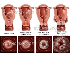 Image result for Cervical Cancer