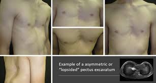 Image result for Pectus Excavatum