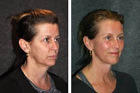 Facelift surgery includes various surgical procedures to improve the face's appearance. Mini Facelift World Renown Mini Facelift Specialist In New York