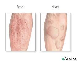 Allergic Reaction Causes Symptoms Treatment Allergic Reaction