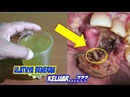 Bagaimana cara menghilangkan karang di gigi? Cara Mengeluarkan Ulat Dan Cara Menyembuhkan Sakit Gigi Dengan Cepat Dan Alami Sehat Tube Youtube Gigi Penyakit Penyembuhan