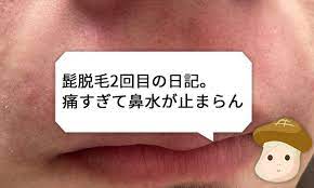 2回目 トリアで髭を脱毛した体験談 痛すぎて鼻水が出る トリア 脱毛 髭