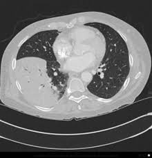 Ta je zkoumána od roku 1976, kdy se jí v. Legionella Pneumonia When To Suspect Diagnostic Considerations And Treatment Strategies For Hospital Based Clinicians Springerlink