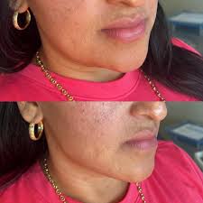 Houston Aesthetic Injector -Andrea Lopez