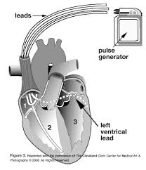 Pacemakers and cardiac devices pacemaker & crt: Sudden Cardiac Arrests And Automated Implantable Cardioverter Defibrillators Aicds Cath Lab Digest